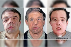 Frenchman becomes world's first person to undergo two face transplants